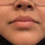 Lip Filler Before & After Patient #139