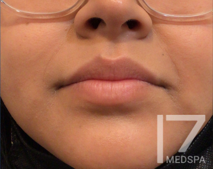 Lip Filler Before & After Patient #139