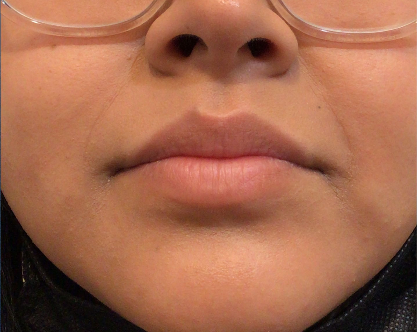 Lip Filler Before & After Patient #139