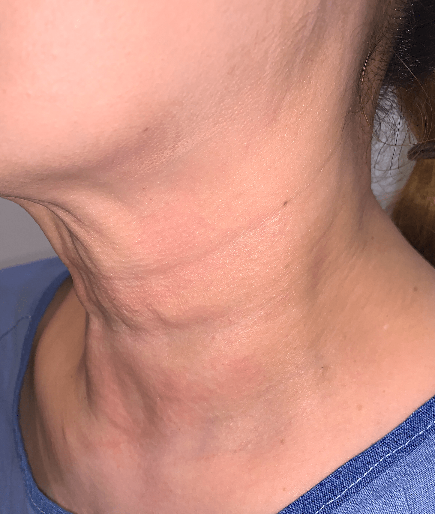 Neck Filler Before & After Patient #142