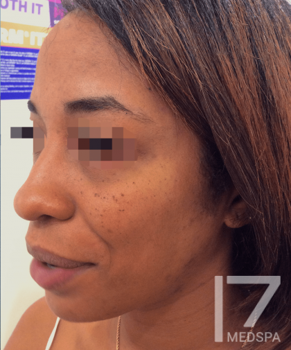 Under Eye Filler Before & After Patient #156