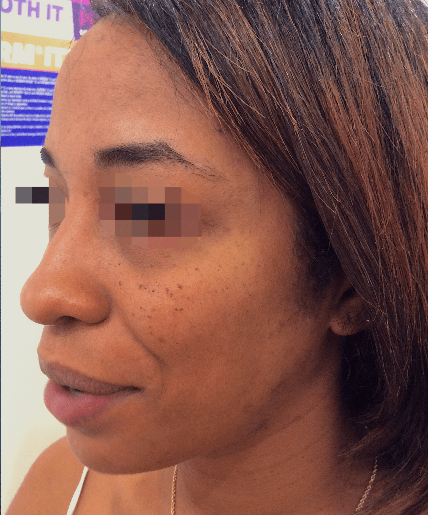 Under Eye Filler Before & After Patient #156