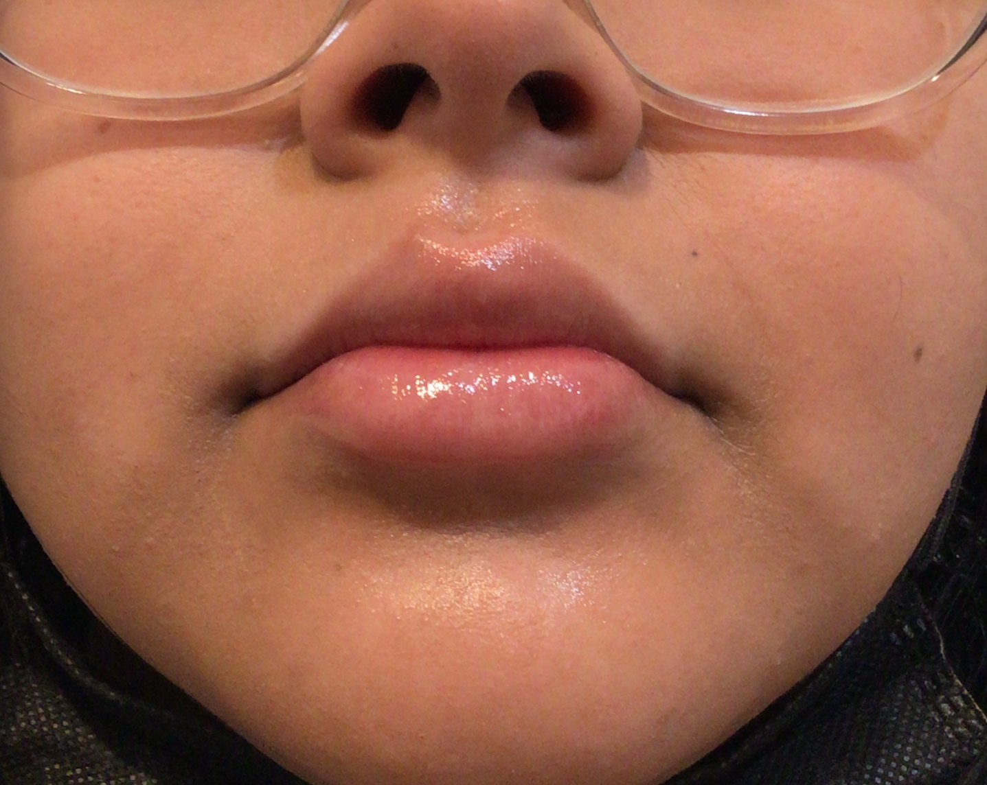 Lip Filler Before & After Patient #139
