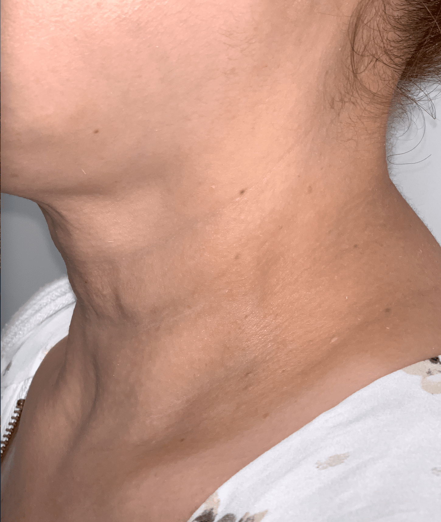 Neck Filler Before & After Patient #142