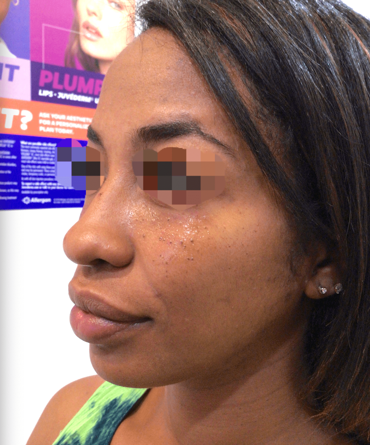 Under Eye Filler Before & After Patient #156