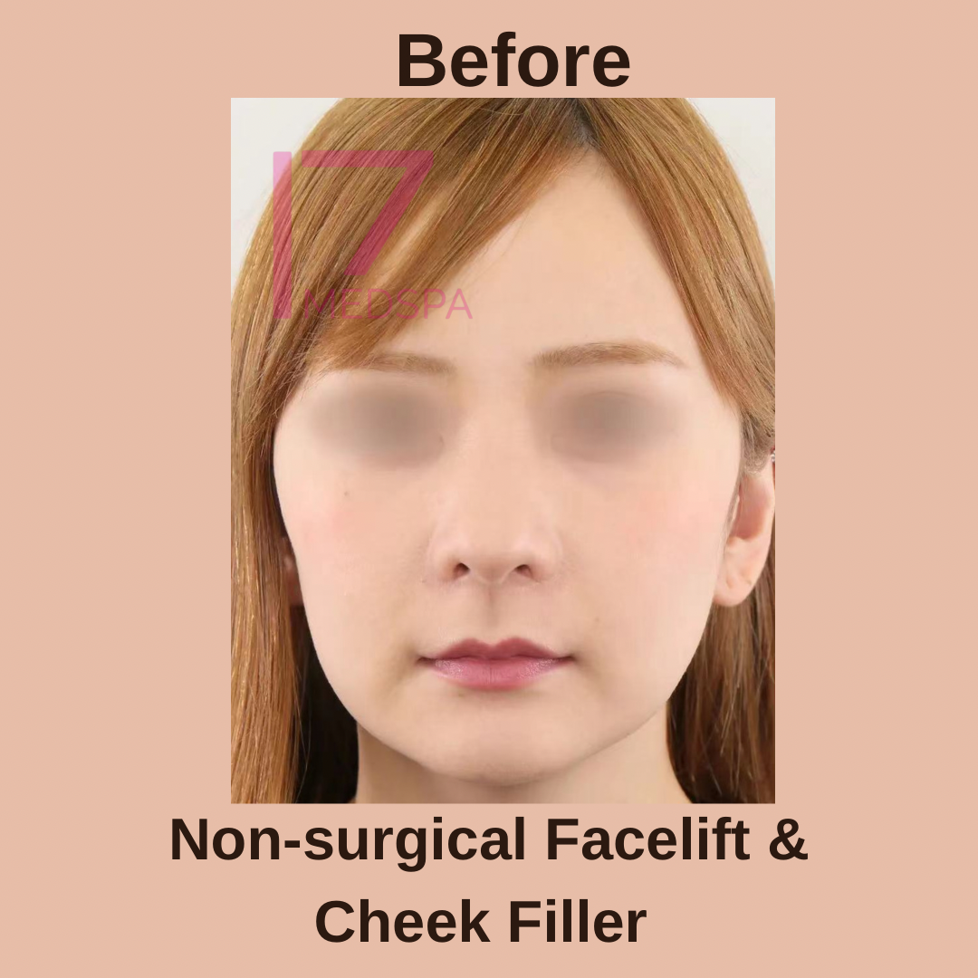 Facelift Before & After Patient #404