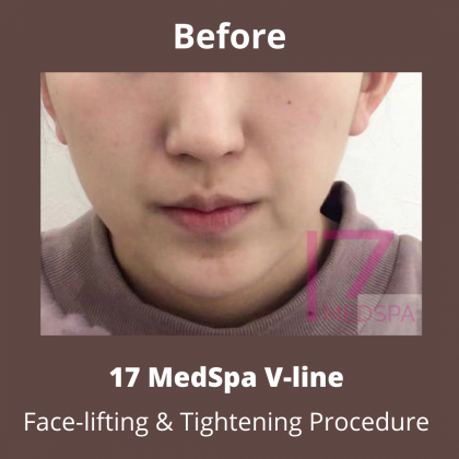 Face Tightening Before & After Patient #407