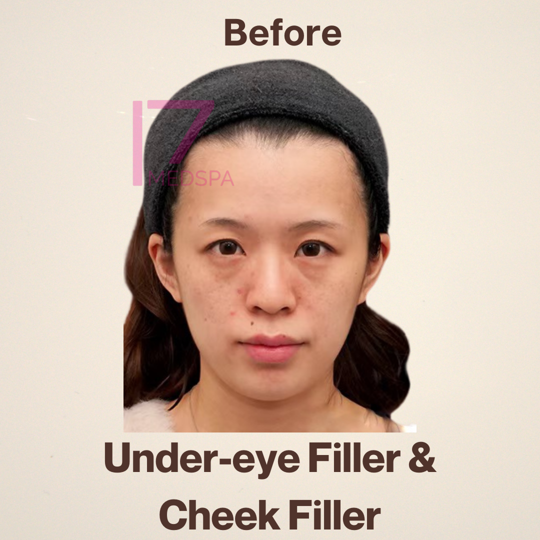Cheek Filler Before & After Patient #410