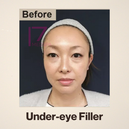 Under Eye Filler Before & After Patient #413