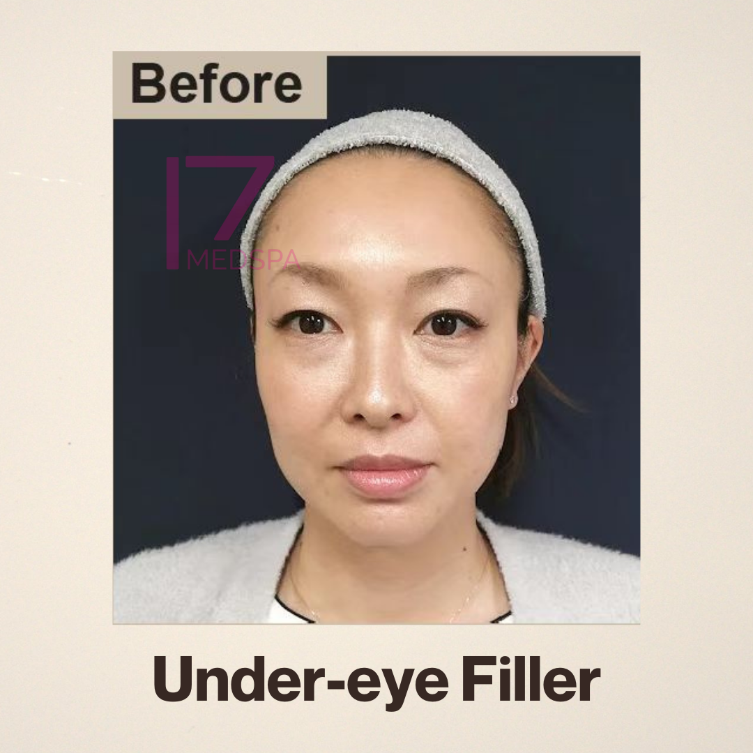 Under Eye Filler Before & After Patient #413