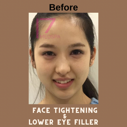 Face Tightening Before & After Patient #400