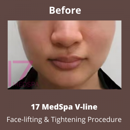 Face Tightening Before & After Patient #416