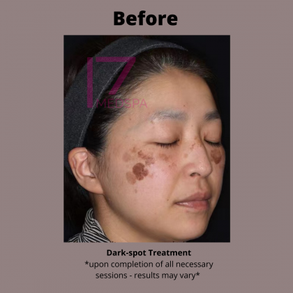 Dark Spot Treatment Before & After Patient #419