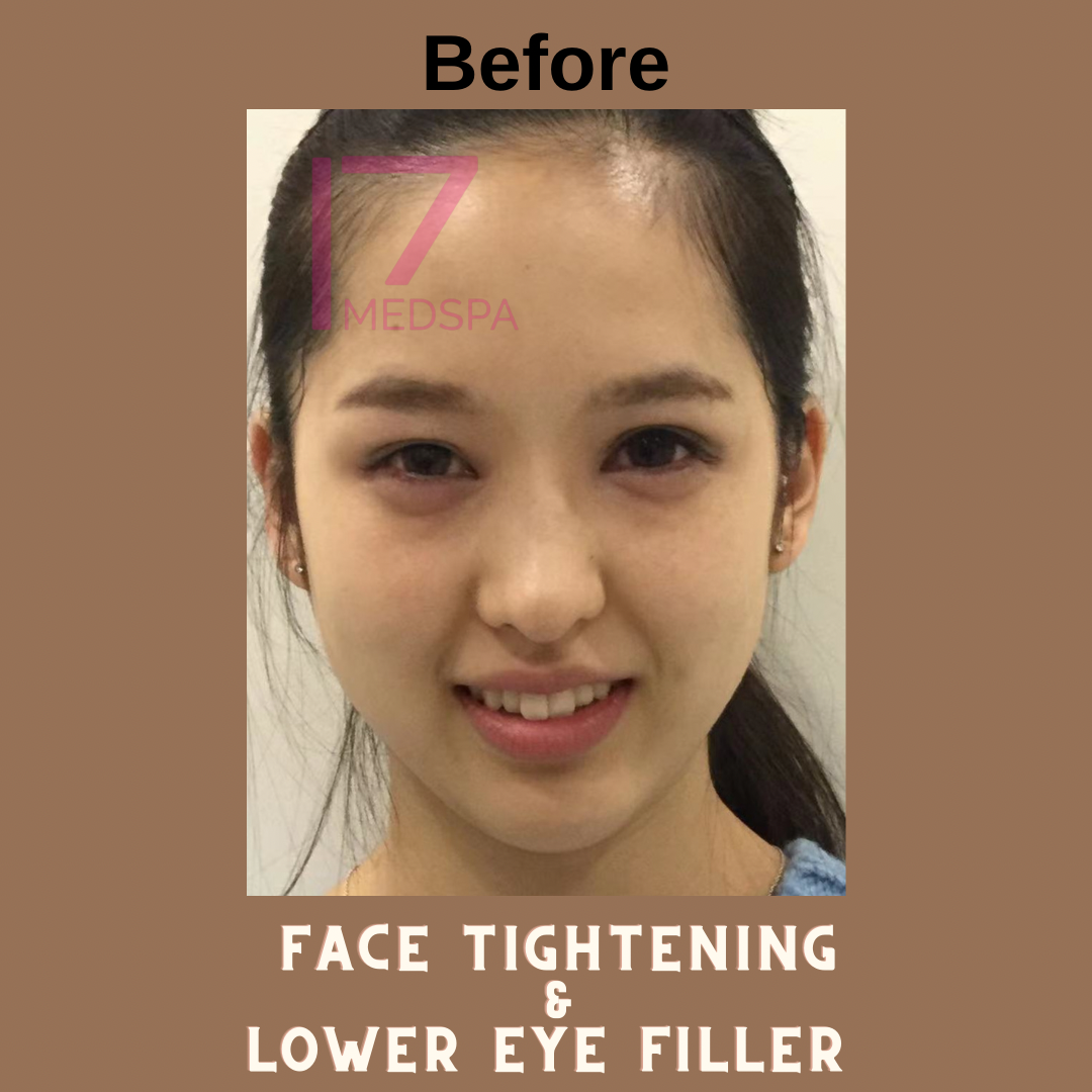 Lower Eye Filler Before & After Patient #400