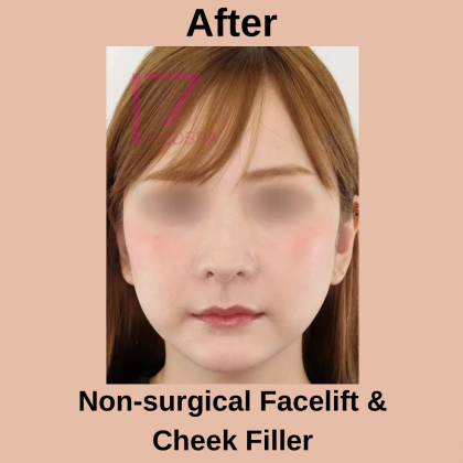 Cheek Filler Before & After Patient #404