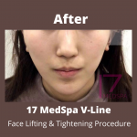 Face Tightening Before & After Patient #407
