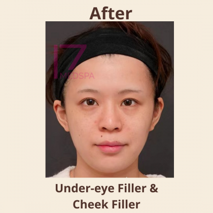 Under Eye Filler Before & After Patient #410