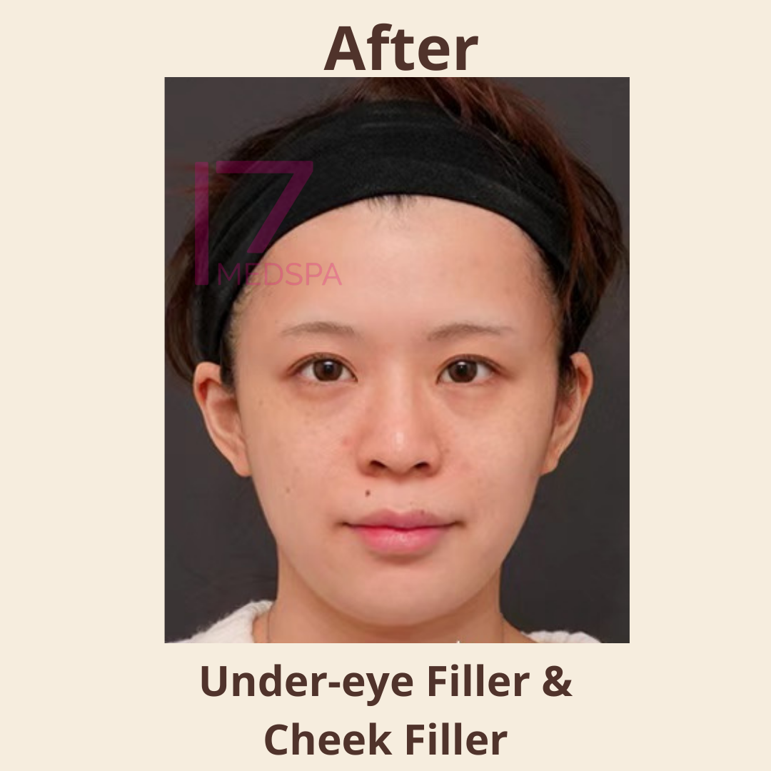 Cheek Filler Before & After Patient #410