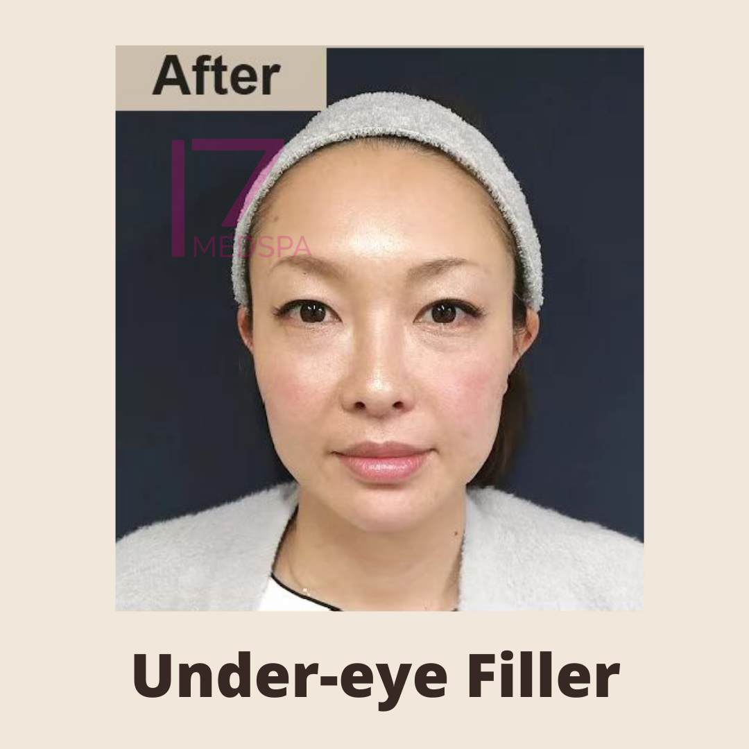 Under Eye Filler Before & After Patient #413