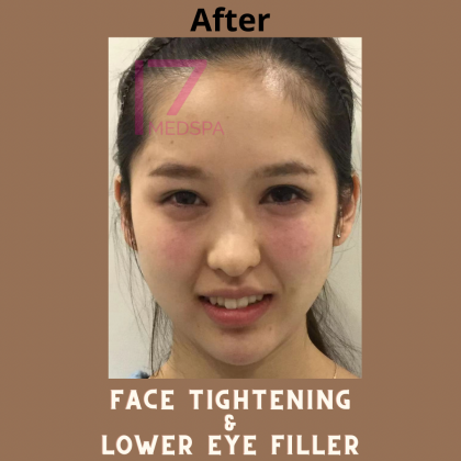 Face Tightening Before & After Patient #400