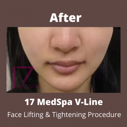 Face Tightening Before & After Patient #416