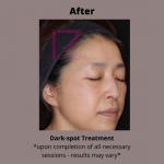 Dark Spot Treatment Before & After Patient #419