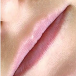 Lip Filler Before & After Patient #545