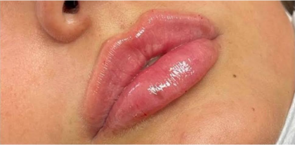 Lip Filler Before & After Patient #584