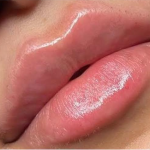 Lip Filler Before & After Patient #586