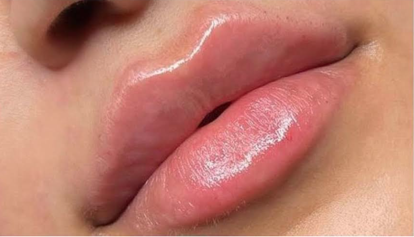 Lip Filler Before & After Patient #586