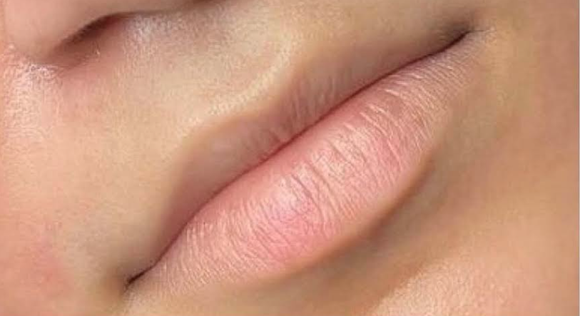 Lip Filler Before & After Patient #586