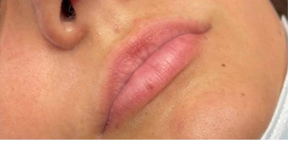 Lip Filler Before & After Patient #584