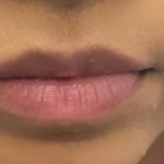 Lip Filler Before & After Patient #590