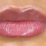 Lip Filler Before & After Patient #590