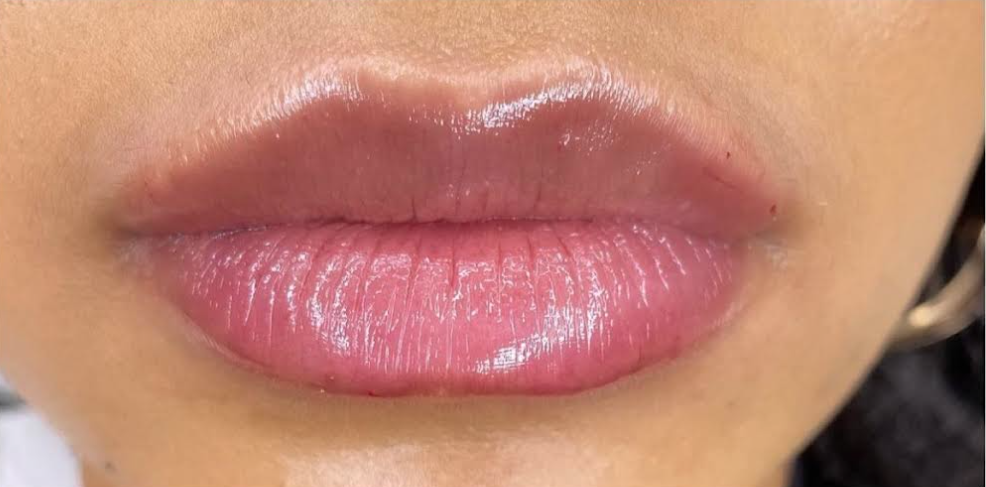 Lip Filler Before & After Patient #590