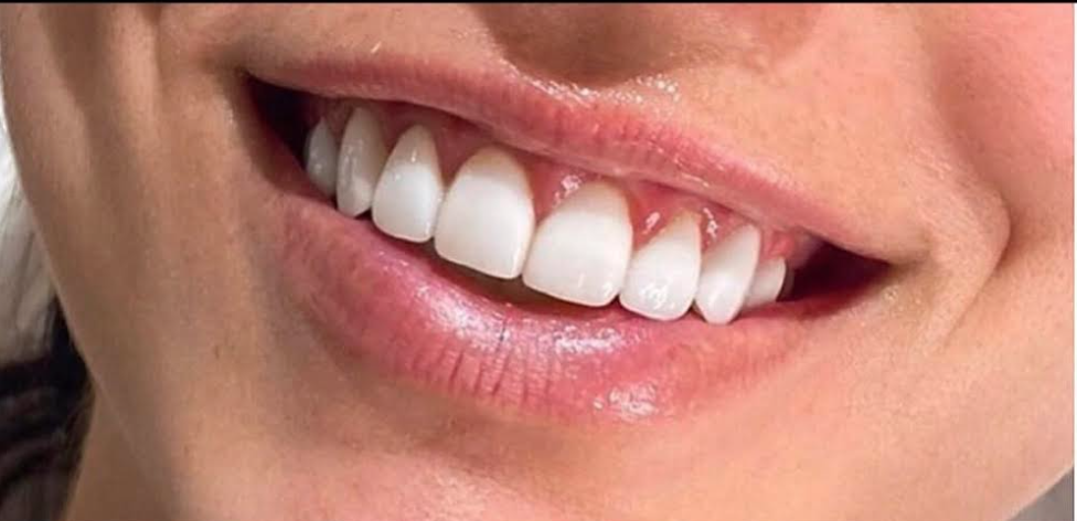 Lip Filler Before & After Patient #591