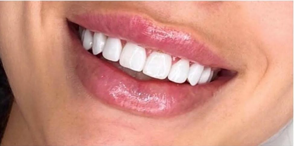 Lip Filler Before & After Patient #591
