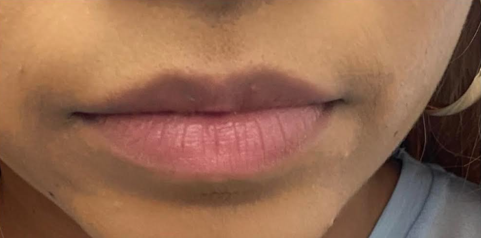 Lip Filler Before & After Patient #590