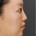 Forehead Filler Before & After Patient #592