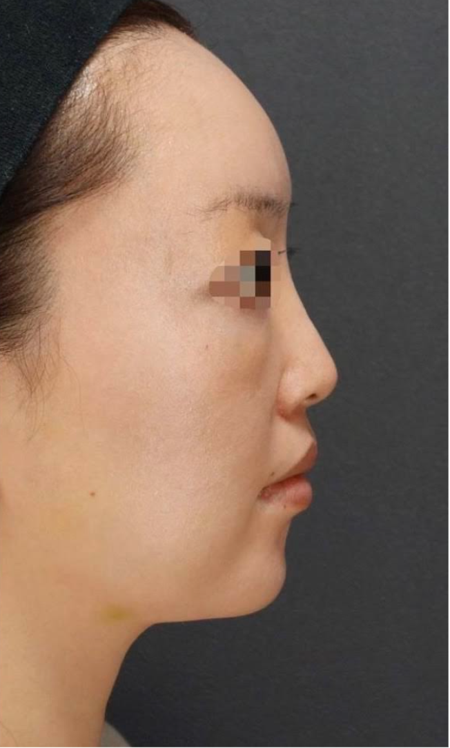 Forehead Filler Before & After Patient #592