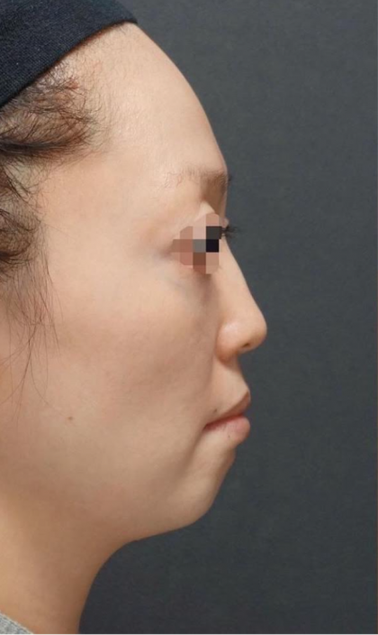 Nose Filler Before & After Patient #592