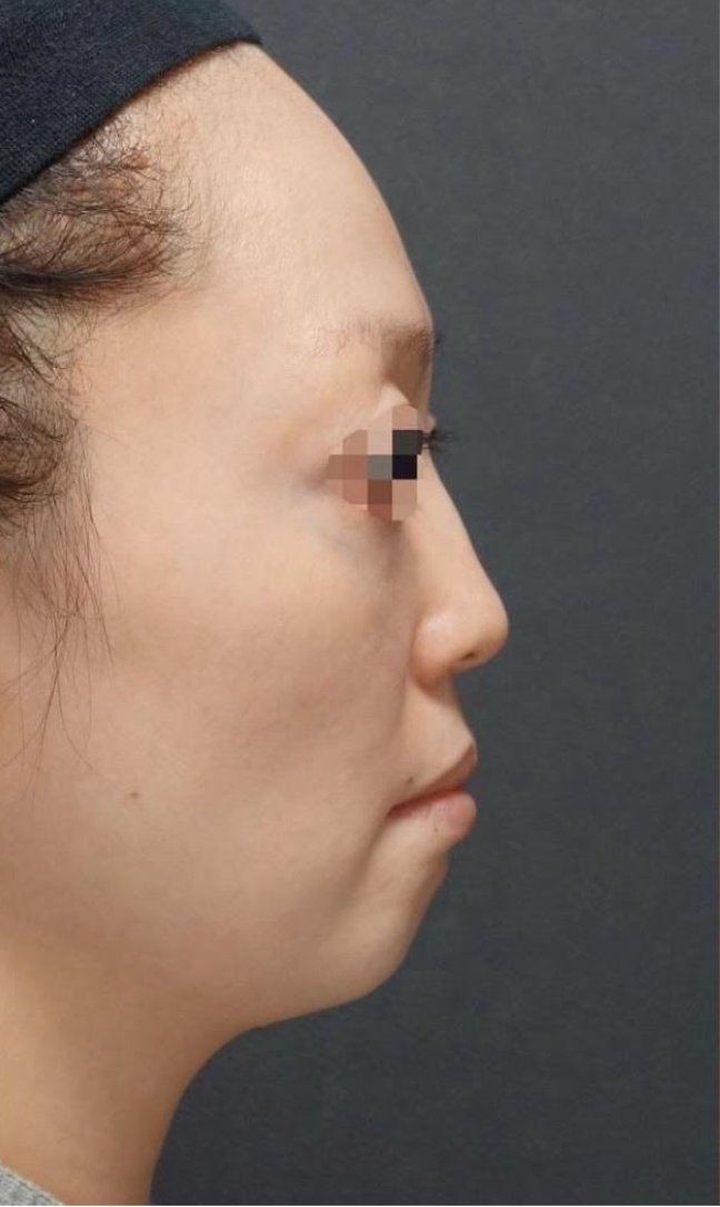 Forehead Filler Before & After Patient #592