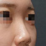 Nose Filler Before & After Patient #593