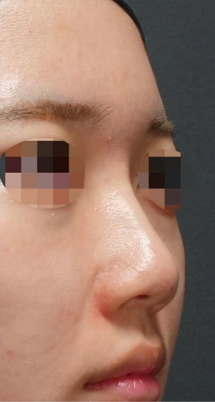 Nose Filler Before & After Patient #593