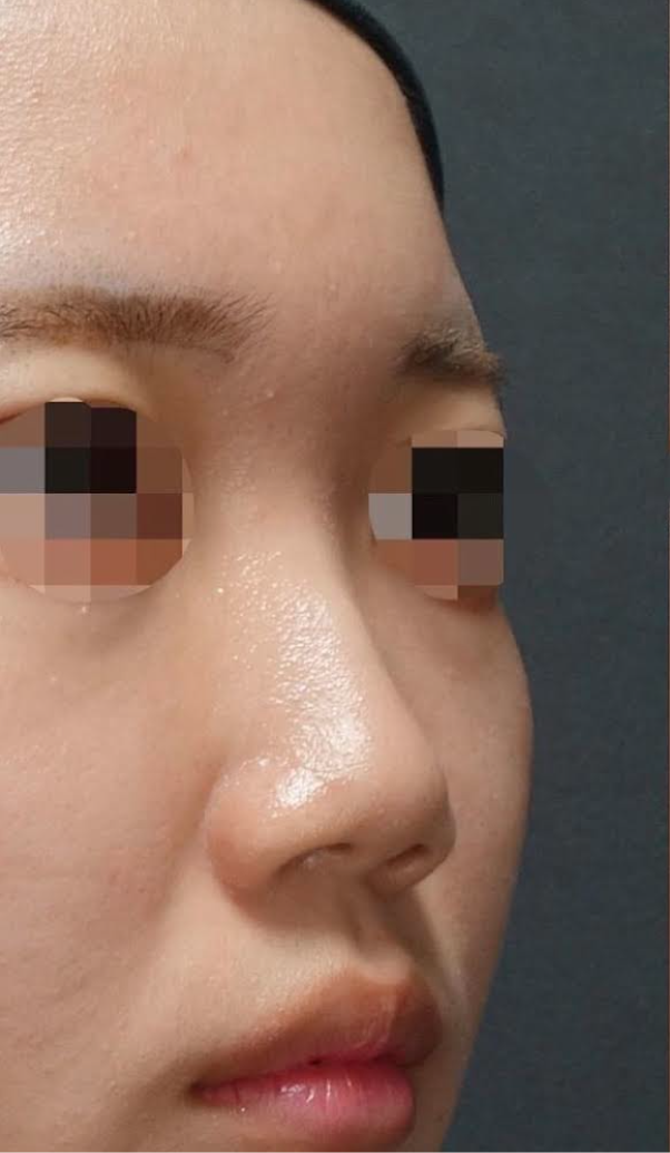 Nose Filler Before & After Patient #593