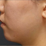 Chin Filler Before & After Patient #594
