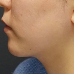 Chin Filler Before & After Patient #594