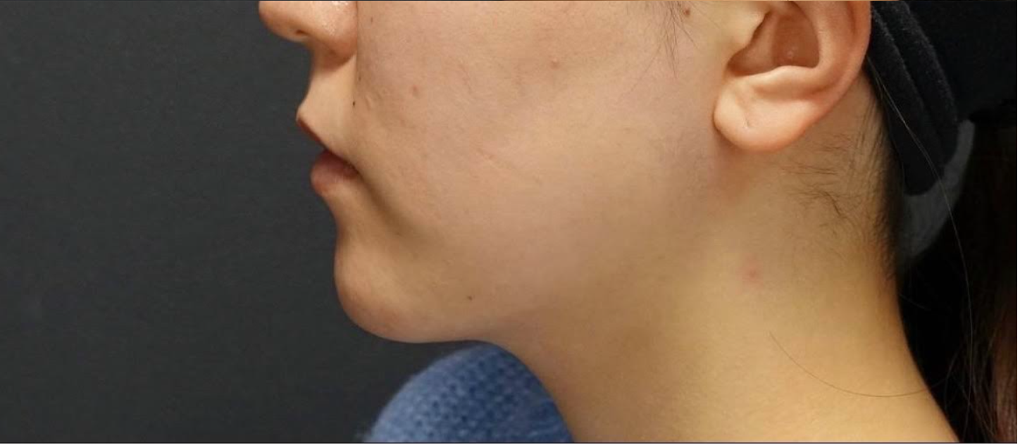 Fat Dissolving Injection Before & After Patient #594
