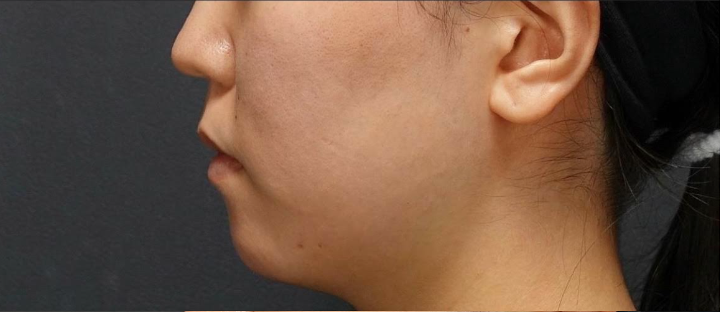 Fat Dissolving Injection Before & After Patient #594