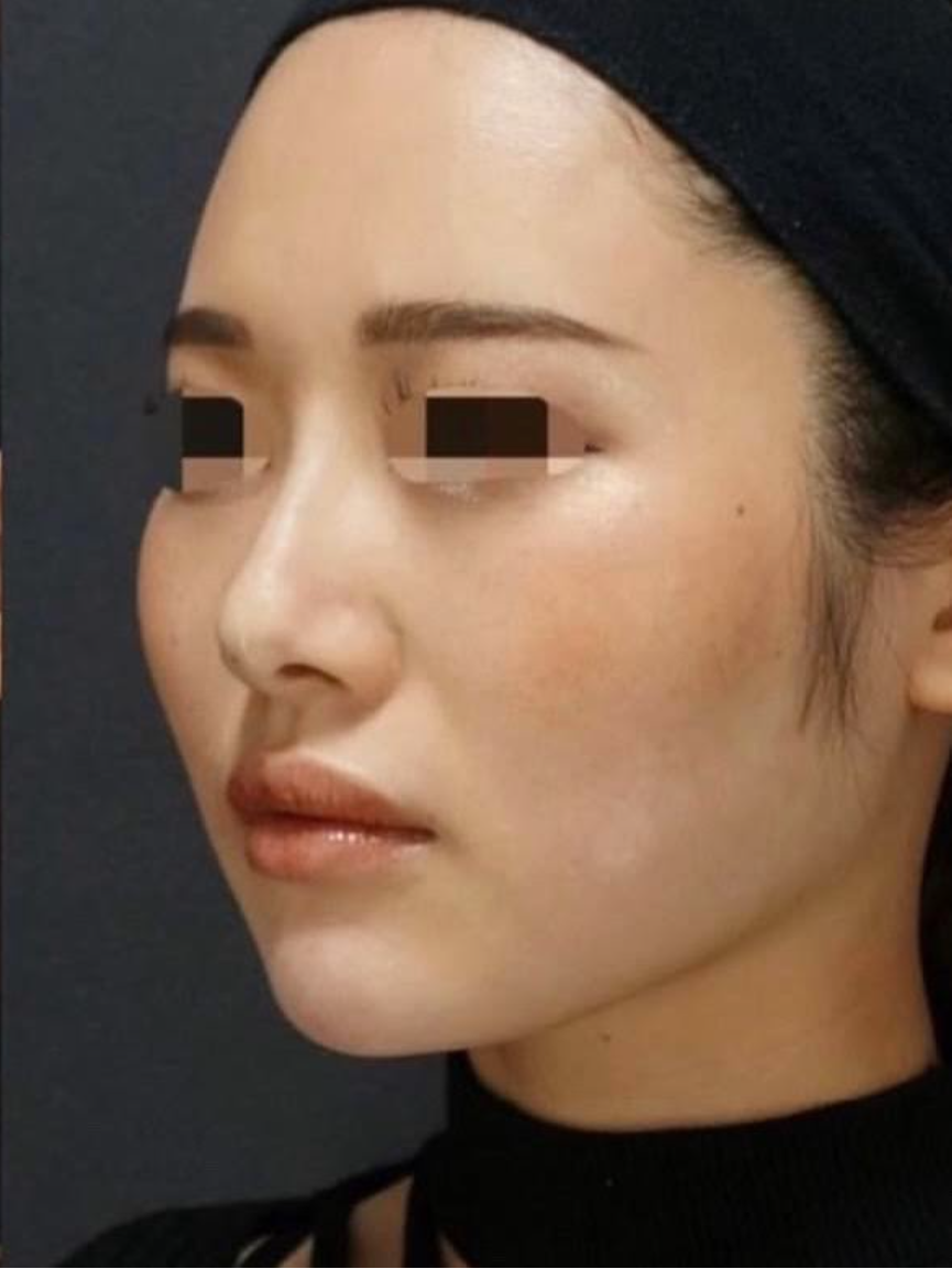 Nose Filler Before & After Patient #595